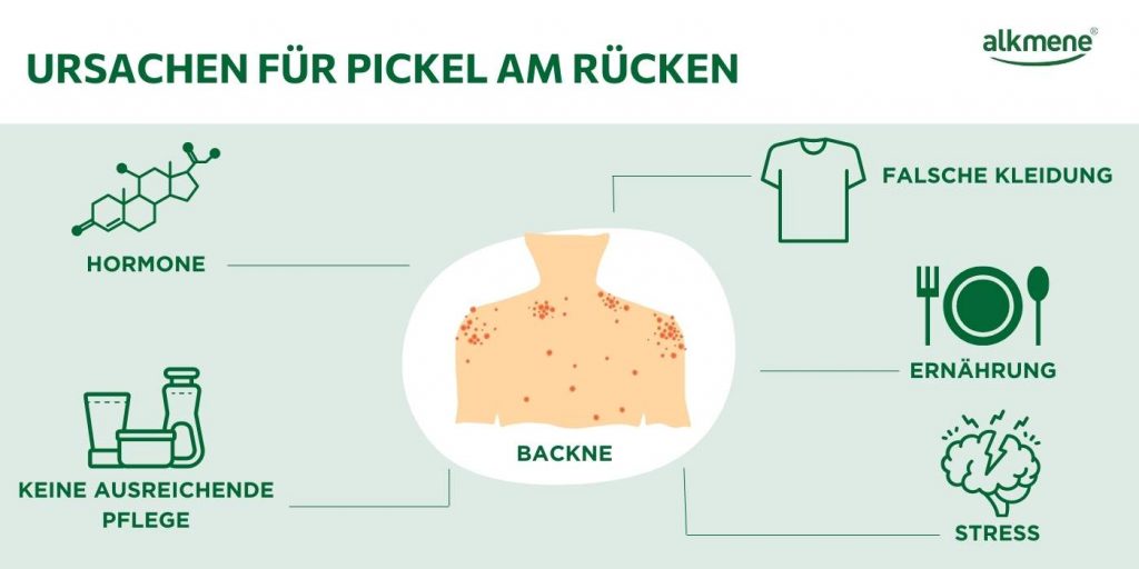 Ursachen für Backne und Pickel am Rücken Infografik