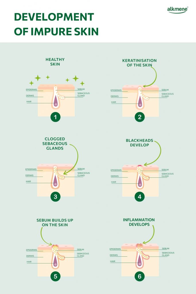 development of impure skin infographic