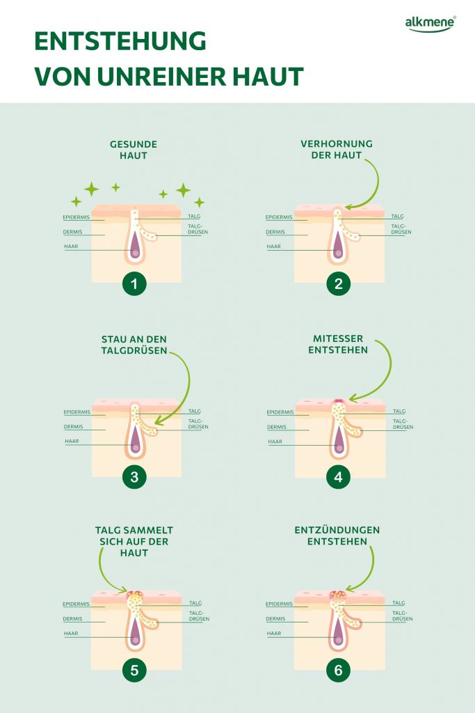 Entstehung von unreiner Haut Infografik