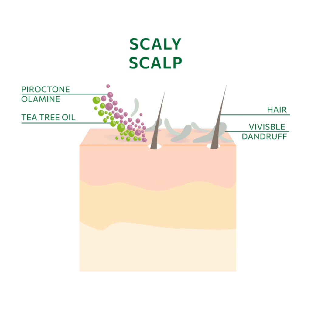 Scaly Scalp Infografik Englisch
