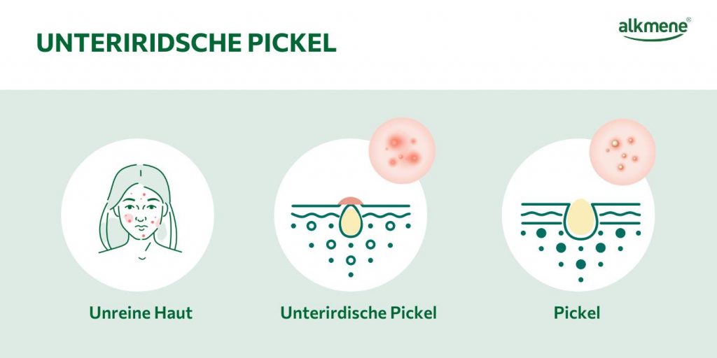 Entstehung von unterirdischen und verkapselten Pickeln