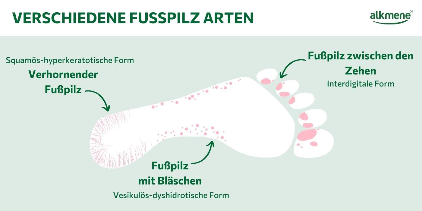 Fußpilz erkennen: Infografik zu den drei verschiedenen Arten von Fußpilz