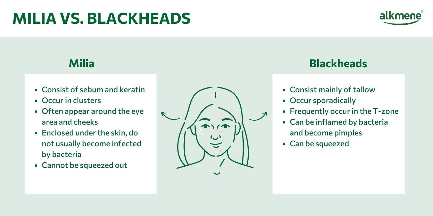 Infografic on the differences between milia and blackheads