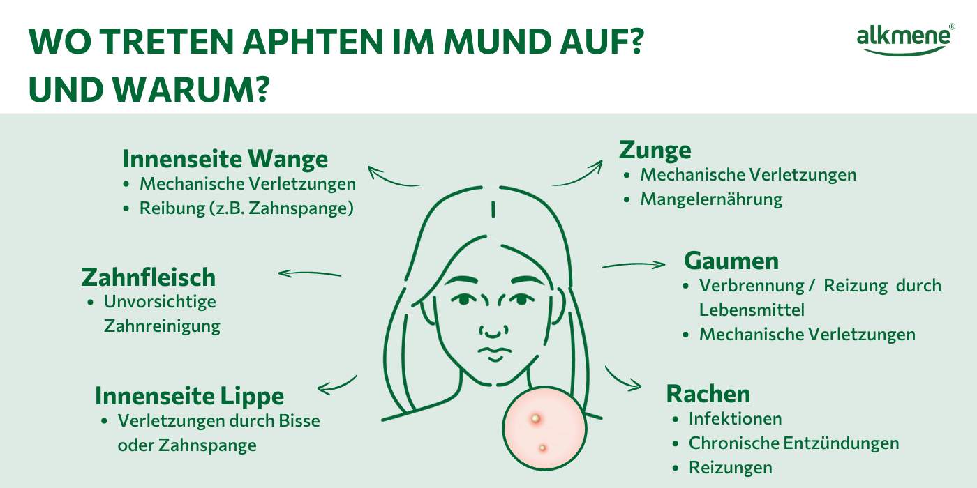 Infografik zum Auftreten von Aphten im Mund