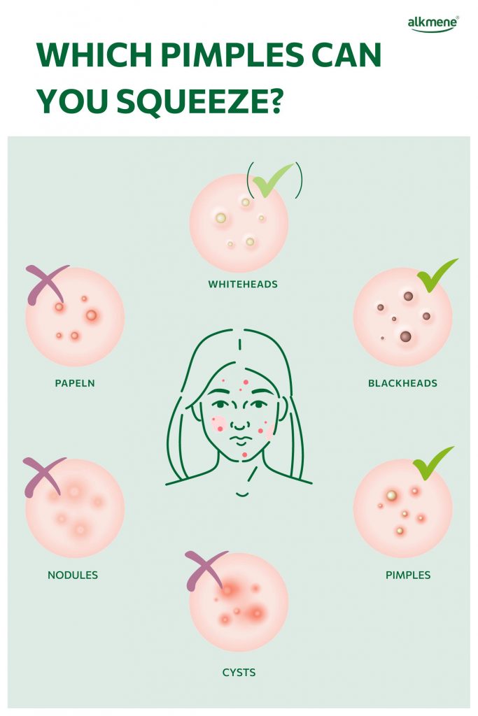 Infografic on which pimples you can squeeze ot